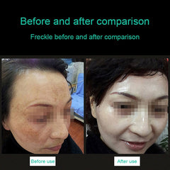 Handheld Picosecond Portable (Removing Tattoo Freckle Mole Dot) Machine Laser Plasma Beauty Care Pen, USB / Blue Light, USB / Red Light