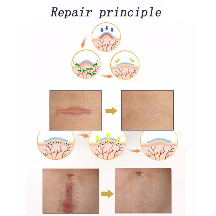 Organic silicone Gel Scar Therapy Patch  be Washed and Reused Organic silicone Gel Scar Therapy Patch  be Washed and Reused