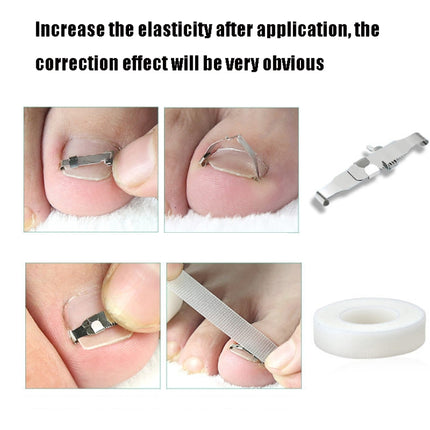 Orthopedic Buckle Toe Nail Groove Ingrown Nail Corrector, No. 36 Positive Nail Buckle, No. 38 Positive Nail Buckle, No. 40 Positive Nail Buckle, No. 42 Positive Nail Buckle, No. 44 Positive Nail Buckle, No. 36 Set, No. 38 Set, No. 40 Set, No. 42 Set   ...