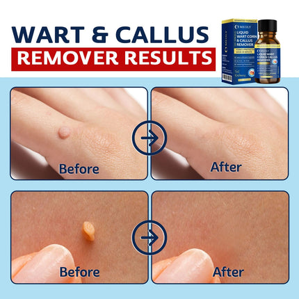 MEOLY Fast-Acting Wart Remover Freeze Off – Plantar Warts, Corns & Calluses, 30 ml