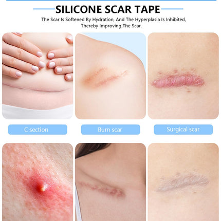 Somlzu Silicone Scar Sheets | 1.6 x 60 Inch Medical Grade Roll (1.5M)