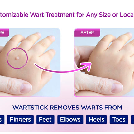 WartStick Maximum Strength Salicylic Acid Solid-Stick Wart Remover 2 Pack – 0.4 oz